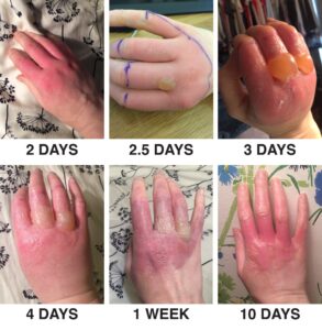 Fitofotodermatoza i pęcherze na skórze dłoni po kontakcie z wyciskanym olejkiem cytrusowym i promieniowaniem UV słońca